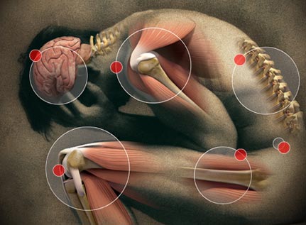 Picture of muscularskeletal body with pain hotspots